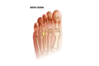 Recovering from Morton's Neuroma Surgery