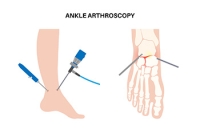 How Arthroscopic Ankle Surgery Works