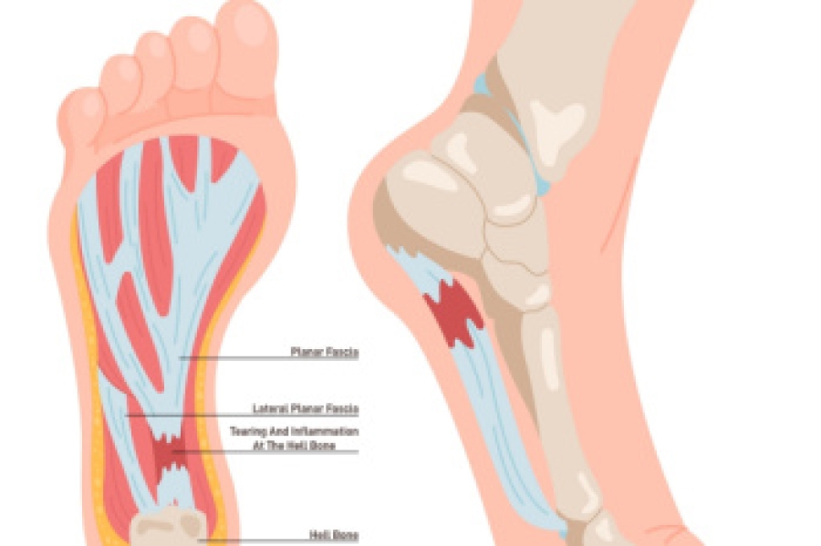 Causes and Symptoms of Plantar Fasciitis