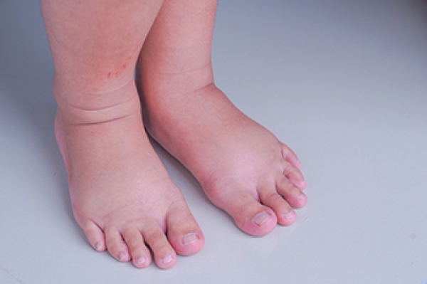 What Swollen Feet in Late Pregnancy Can Mean