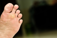 A Closer Look at Stubborn Spots Under the Foot