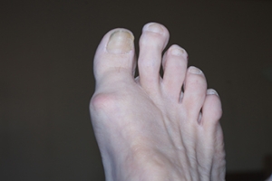 What Is Morton&#039;s Toe?